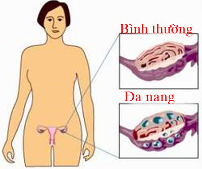 Buồng trứng đa nang có gây vô sinh?